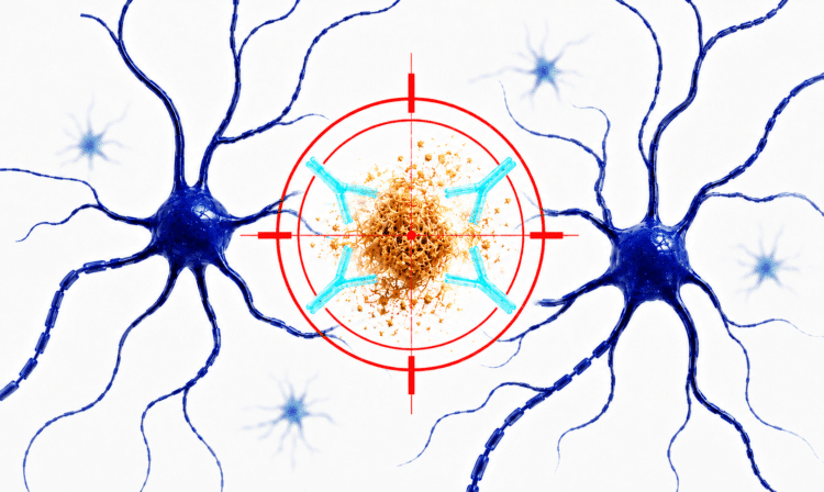 Servicio de Neurorrehabilitación Intensiva Tratamiento antiamiloide del Alzheimer en Granada: anticuerpos dirigidos contra una placa de beta-amiloide entre neuronas.